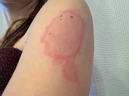 Check spelling or type a new query. Covid Arm Skin Reactions At Injection Site Of Moderna Vaccine In Bc Case Reports British Columbia Medical Journal