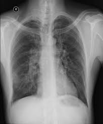 Plicní embolie (pe) popisuje zablokování plicní arterie nebo jedné z jejích větví krví sraženinou nebo cizorodým materiálem. Plicni Embolie