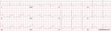 Posterior Wall Myocardial Infarction Mi Ecg Review Criteria And Examples Learntheheart Com