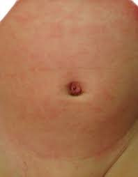 Guia De La Piel Ronchas Urticaria