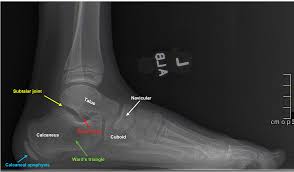 Image result for Calcaneal Apophysitis