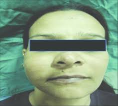 Extraoral photograph of the patient