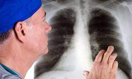 Lung cancer screening refers to cancer screening strategies used to identify early lung cancers before they cause symptoms, at a point where they are more likely to be curable. How Lung Cancer Is Diagnosed