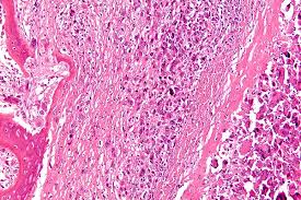 A patient may also experience a pathological fracture as the first sign of bone cancer. Bone Tumor Wikipedia
