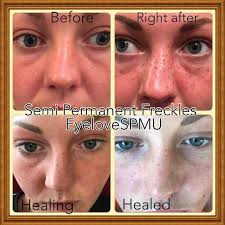 The Controversial Freckletattoo Showing The Stages Of Healing Using Semipermanentmakeup Enhancing The Client Tattooed Freckles Faux Freckles Enhance Freckles