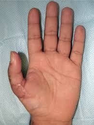 Spanish does not differentiate between fingers and toes. Cirugia Reconstructiva De La Mano Sciencedirect