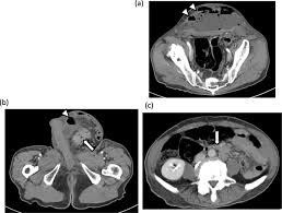 Causes, symptoms, risk factors, and. Incarcerated Sigmoid Colon Cancer In An Inguinal Hernia Sac Associated With An Abdominal Wall Abscess A Case Report Surgical Case Reports Full Text