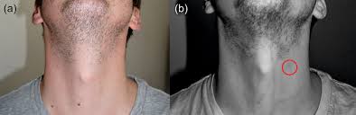 Image result for Strangulation Injury