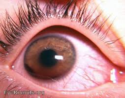 Image result for Hyphema