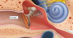 Crush some garlic and warm it with extra virgin olive oil (evoo). Are Ear Plugs Necessary After Ear Tubes