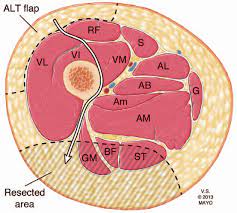 We did not find results for: An Axial Illustration Of The Proximal Thigh Demonstrating The Anatomy Download Scientific Diagram
