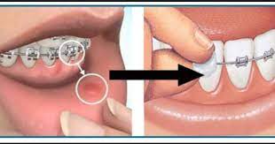 Robison Orthodontics Mesa Arizona Robison Orthodontics Mesa Az Cheeks And Lips Irrit Dental Braces Orthodontics Braces