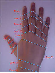 Image result for Elson Extensor Tendon Test