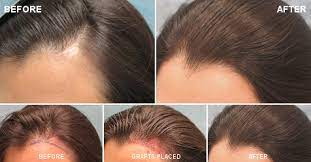 Spironolactone is a part of a family of medications called aldosterone receptor antagonist. Hair Loss In Women Female Hair Loss Bernstein Medical