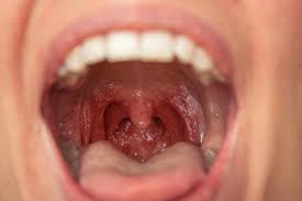 Tonsillitis