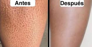 ⚠️⚠️Que es la QUERATOSIS PILARIS ❓ ➡️Mejor conocida como "Piel de Gallina".  NO es una enfermedad, sino un condición genética en la piel. ➡️Consiste en  protuberancias, que en realidad son células muertas,