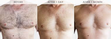 Communities>men's health>growing lump in between my buttocks. Laser Hair Removal For Men