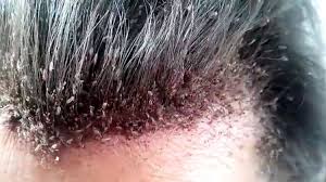 Maybe you would like to learn more about one of these? Dry Scalp Vs Lice What S The Difference