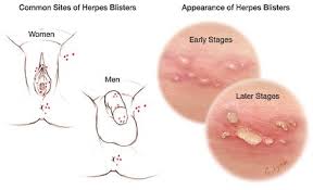 Image result for genital herpes women