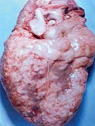 Learn about pericardial disease and its causes for some people, no cause can be found. Pericardial Disease