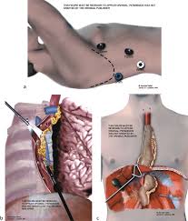 After the tumor is removed, the stomach is attached to the remaining part of the esophagus through the neck incision; Transthoracic Esophagectomy Springerlink