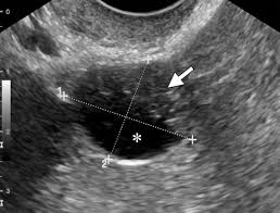 This may include regular pelvic ultrasounds to see if the cyst changes in size or appearance. Imaging Strategy For Early Ovarian Cancer Characterization Of Adnexal Masses With Conventional And Advanced Imaging Techniques Radiographics