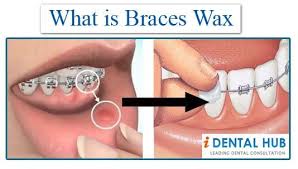 Right after getting your braces though and after each tightening you might want to stick to avoid even just crunchy foods. Pin By Identalhub On Dental Knowledge Identalhub Orthodontics Dental Braces Dental