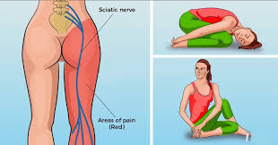7 gentle yoga poses to fix sciatica pain. 8 Yoga Poses For Sciatica Pain Healthylifeboxx