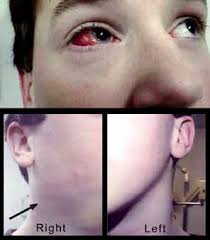 Volume 4 Chapter 4 Parinaud S Oculoglandular Syndrome