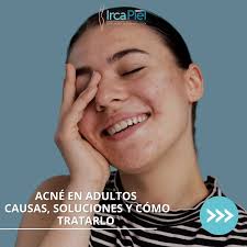 🧐 ¿Por qué sigues lidiando con el acné en la adultez? El acné no solo  afecta a los adolescentes. ¡Es más común de lo que crees en adultos! Si  todavía estás buscando