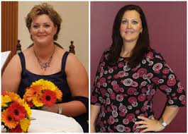 Kelly S Gastric Sleeve Darebin Weight Loss Surgery