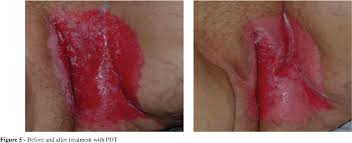 Scielo Brasil Mammary And Extramammary Paget S Disease A Study Of 14 Cases And The Associated Therapeutic Difficulties Mammary And Extramammary Paget S Disease A Study Of 14 Cases And The Associated Therapeutic Difficulties