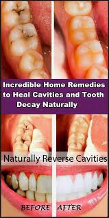Incredible Home Remedies To Heal Cavities And Tooth Decay Naturally Face Errors Tooth Decay Remedies Heal Cavities Tooth Decay