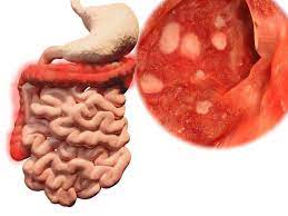Ob du dir deshalb sorgen machen musst. Colitis Ulcerosa Im Uberblick Symptome Ursachen Verlauf Kanyo