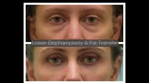 75 Facial Fat Grafting ideas to save today