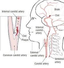 Image result for carotid artery