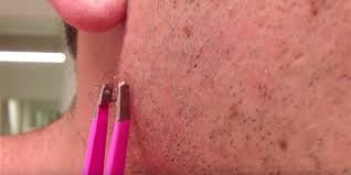 Ingrown armpit lumps are not a infected bumps and ingrown hair cysts, usually from staph or mrsa infections can grow into large. Video The Most Watched Ingrown Hair Removal On Youtube Insider