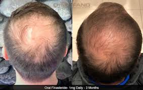 The severity of hair loss can vary from a small area to the entire body. Propecia Finasteride Hair Transplants Hair Loss Restoration In Ct Ma Ri Nh