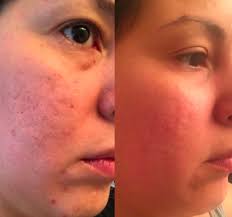 Check spelling or type a new query. 24 Products To Help You Deal With Acne Scars