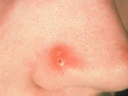 Wenn er doch nur eine kleine harmlose abweichung vom. Pickel Entfernen Mit Diesem Aussergewohnlichen Trick Werden Sie Sie Schnell Los Gesundheit
