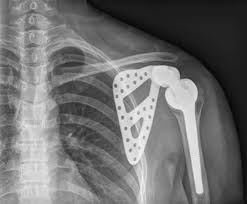 Nous apprécions l'imprimante 3d dremel 3d45 pour ses nombreuses qualités. Quand L Impression 3d Transforme La Medecine Moderne