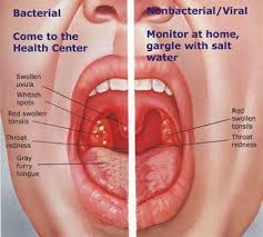 Oct 09, 2020 · palpitations and a feeling of tightness in the throat can accompany a range of conditions. 9 Home Remedies For Sore Throats Treatment For Sore Throat Nursing Tips Homeopathy