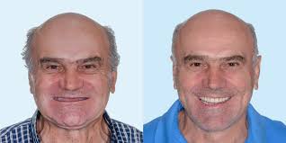 Most people who have received dental implants say that there is very little discomfort involved in the procedure. How Painful Are Dental Implants Laser Dental Victoria
