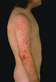 Image result for Papular Acrodermatitis