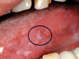 The biopsy specimens are then incubated with enzymatic reagents. New Saliva Test For Oral Cancer