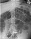 Image result for icd 10 code for distal small bowel obstruction