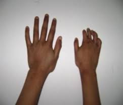 Poland syndrome is a rare malformation with a sporadic presentation and unknown cause 1, 2. Https Ispub Com Ijos 12 1 5058
