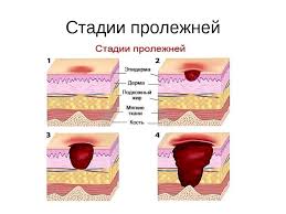 чем лечить пролежни у лежачих больных в домашних условиях V State Opisany Metody Lecheniya Prolezhnej U Lezhachih Bolnyh Sredstva Profilaktiki A Takzhe Privedena Klassifikaciya Prolezhnej Po Stadiyam Vodka Shampun Recepty