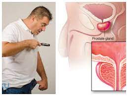 18.03.2018 · prostate cancer symptoms in telugu it was popularised in the 1960s with the release of letraset sheets containing lorem ipsum. à°µ à°·à°£ à°² à°¨ à°ª à°ª à°‰ à°¦ à°® à°• à°• à°¯ à°¨ à°¸à°° à°µà°¸ à°¤ à°¦à°¨ à°­à°¯à°ªà°¡ à°¤ à°¨ à°¨ à°° à°• à°² à°¡ à°¥ à°°à°ª à°¤ à°® à°­à°¯ à°¨ à°¨ à°¦ à°° à°š à°¯ à°¡ How You Can Give Prostate Cancer The Cold Treatment Telugu