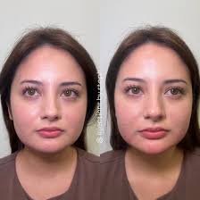 Stephanie Lemmon MS, PAC (@injections.by.steph) • Instagram photos and  videos